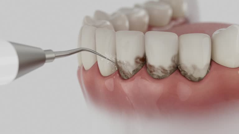 Trusted Wisdom Tooth Removal service in Woodruff, SC - Dentist Open Now